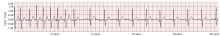 Heart rate spike